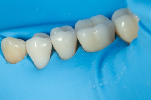 Протезирование зубов