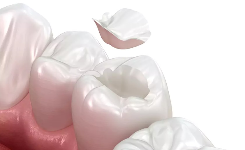 Что такое керамическая вкладка?